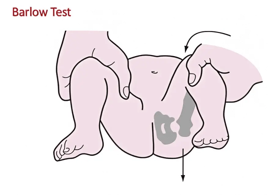 Barlow's Test Orthopedic Special Test