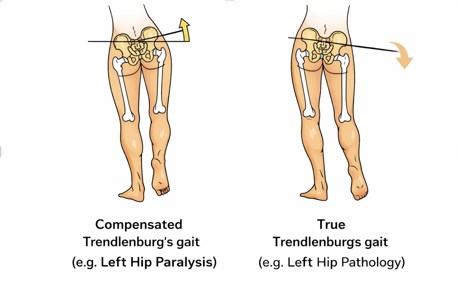 Trendelenburg's Test Orthopedic Special Test