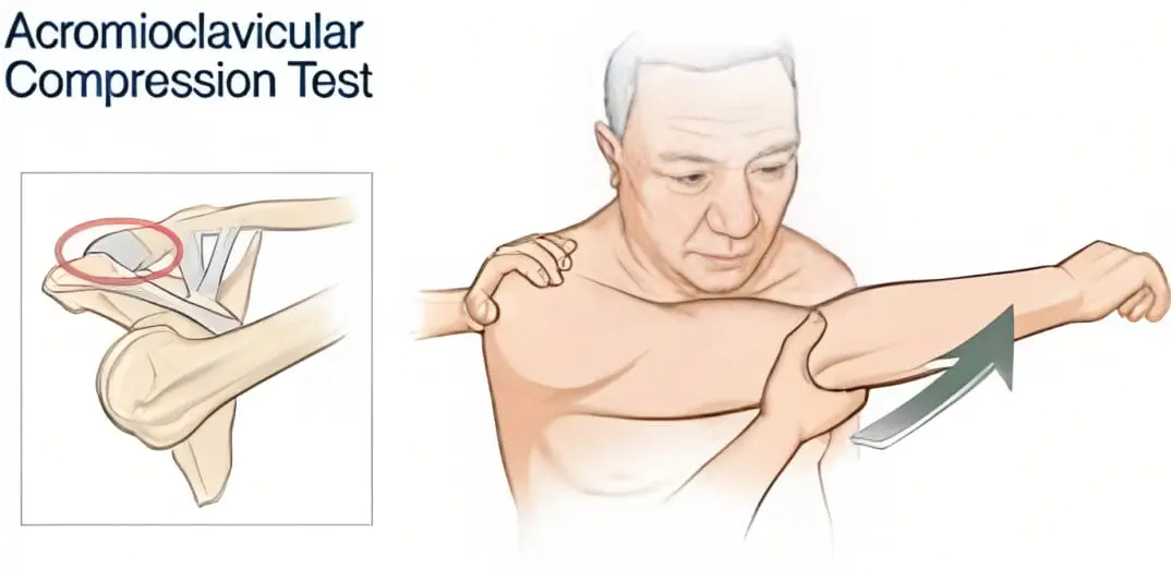 Cross-Body Adduction Test Orthopedic Special Test