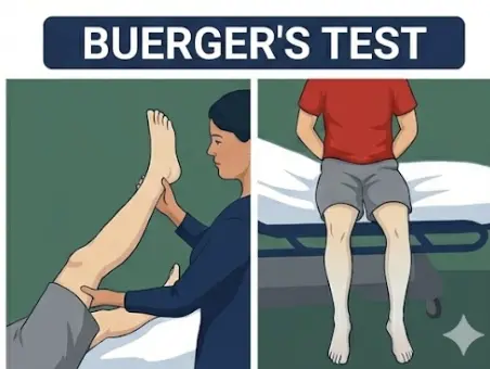 Buerger’s Test Orthopedic Special Test