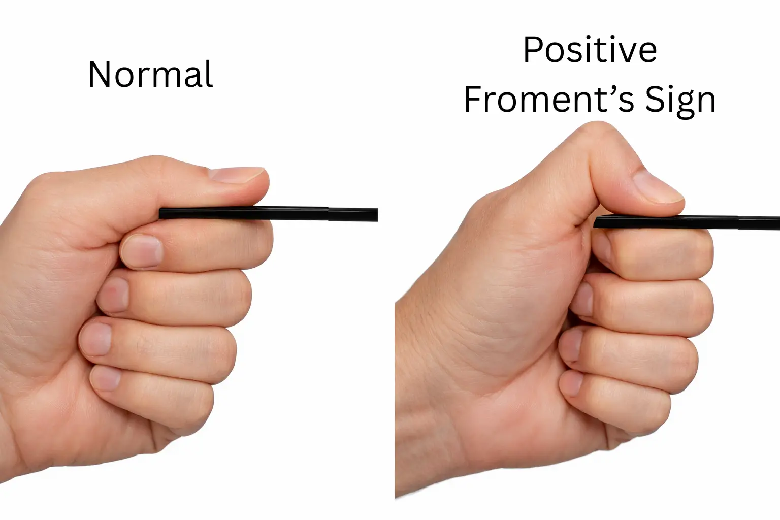 Froment's Sign Orthopedic Special Test