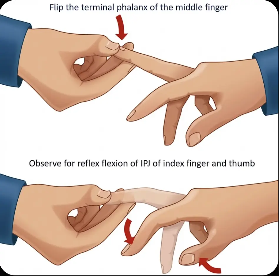 Hoffmann's Sign Orthopedic Special Test
