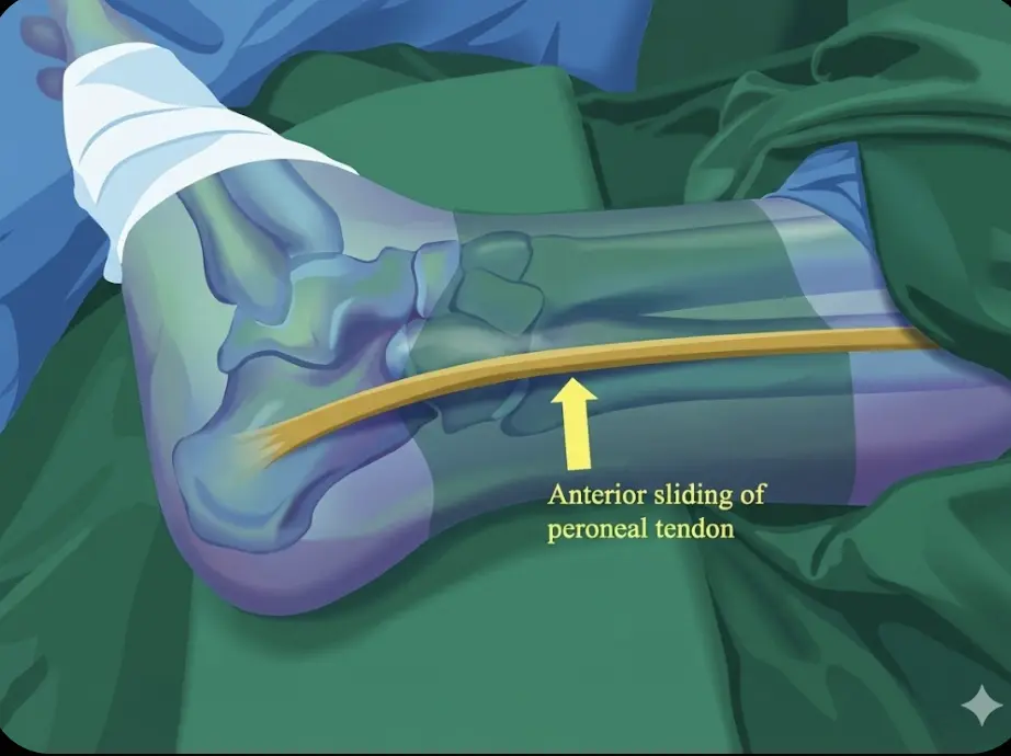 Peroneal Tendon Dislocation Test Orthopedic Special Test