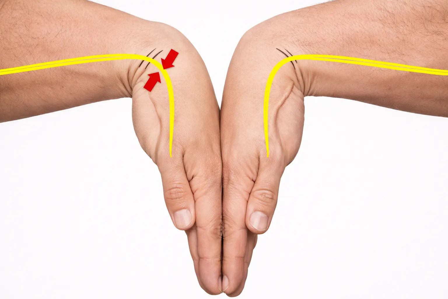 Phalen's Test Orthopedic Special Test