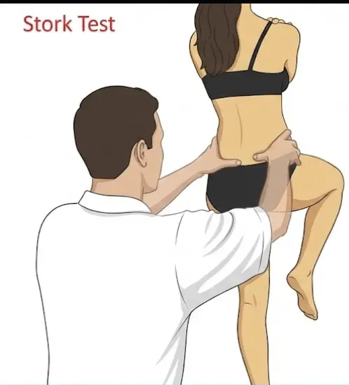 Stork Test (One-Leg Standing Extension) Orthopedic Special Test