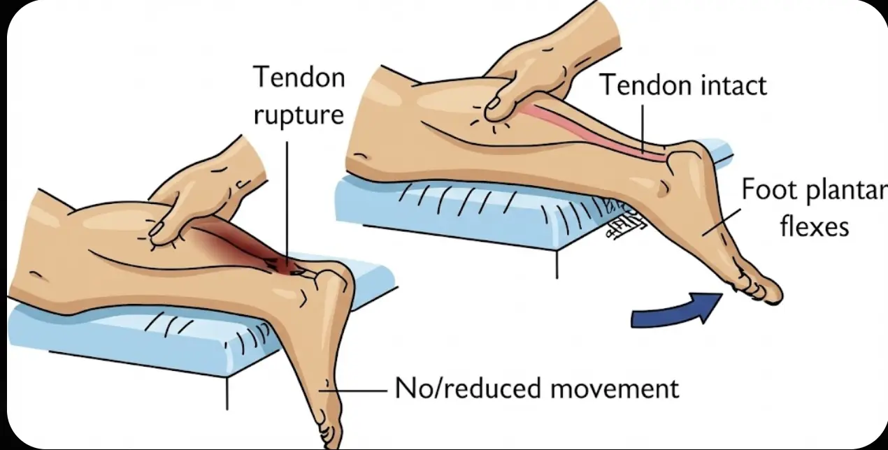 Thompson’s Test Orthopedic Special Test